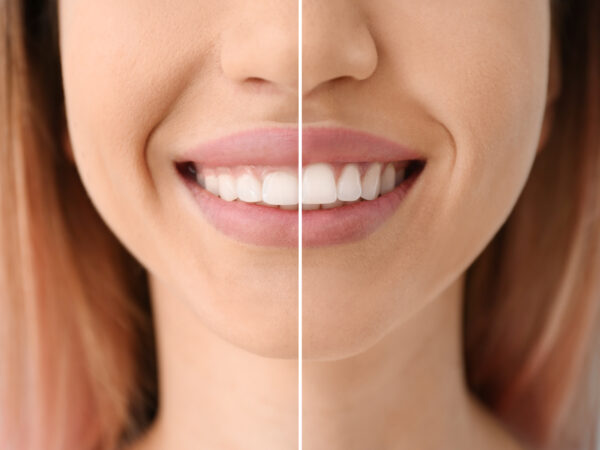 laser dentistry in roseville