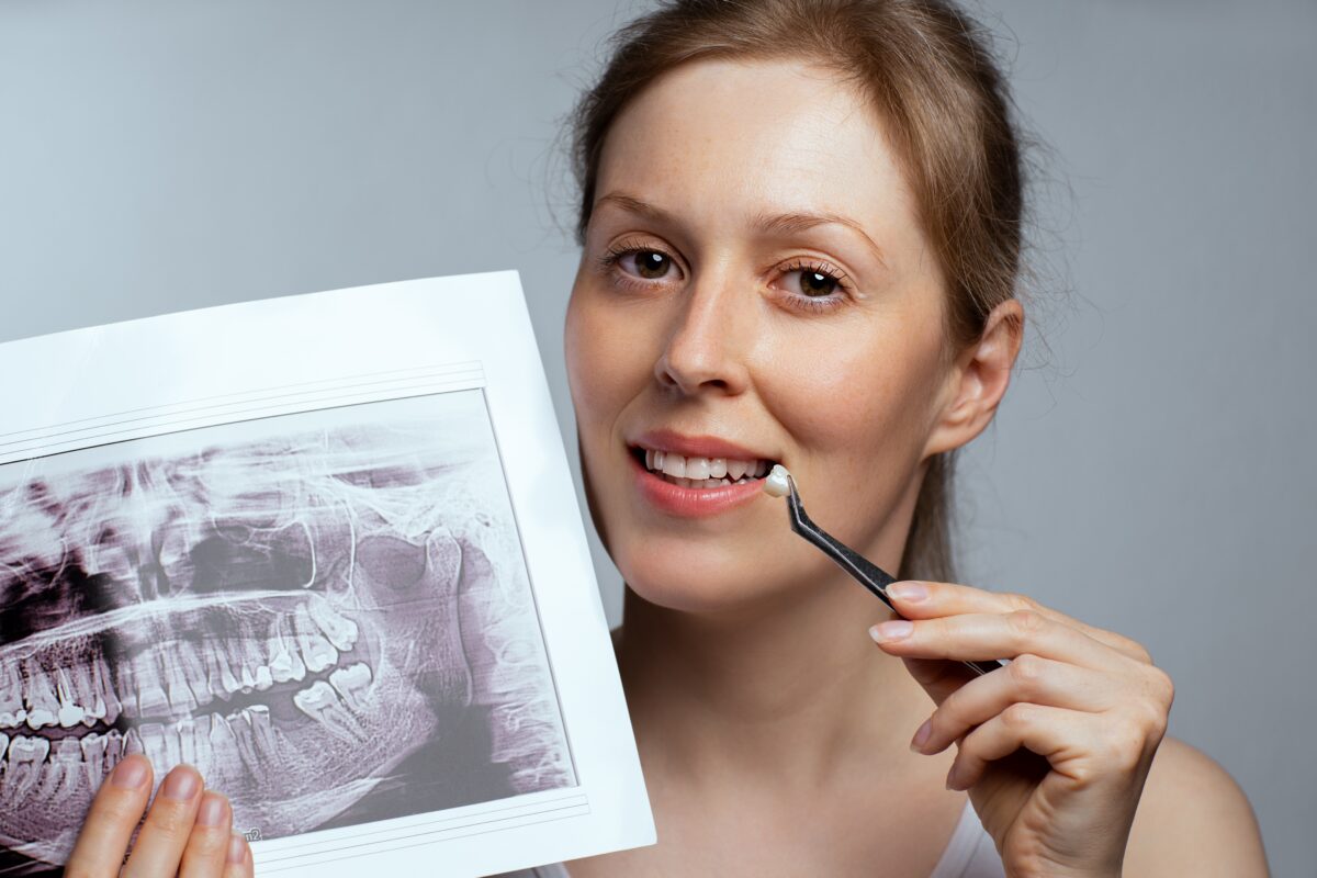 dental crowns in roseville ca